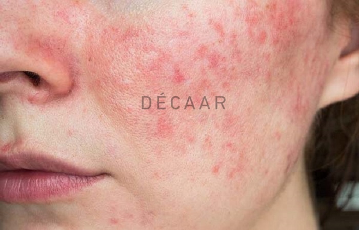 cách phục hồi da mỏng yếu tại nhà